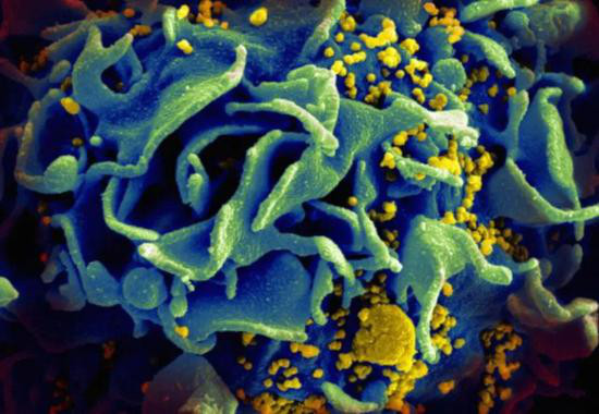 HIV（黄色颗粒）感染表达CD4的免疫T细胞（图片来源：NIH）